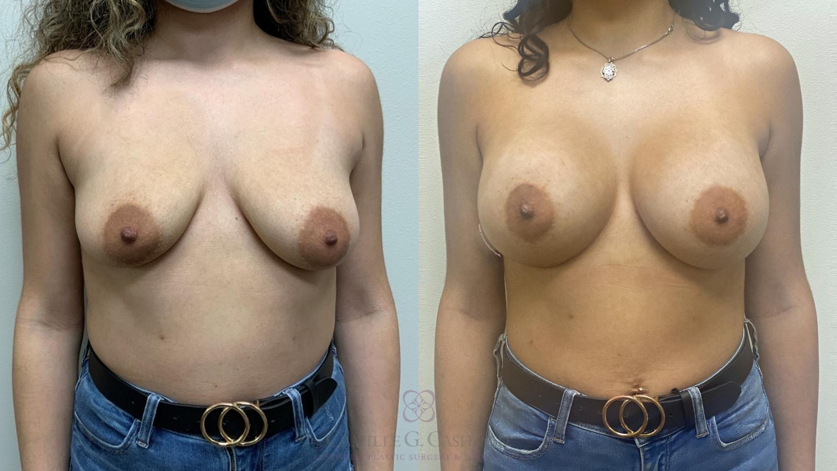 Before & After Breast Augmentation Case 638 Front View in Houston, TX