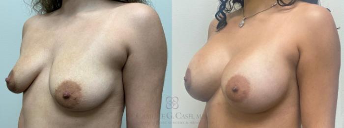 Before & After Breast Augmentation Case 638 Left Oblique View in Houston, TX