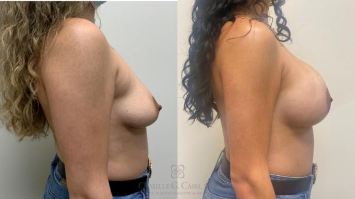 Before & After Breast Augmentation Case 638 Left Side View in Houston, TX