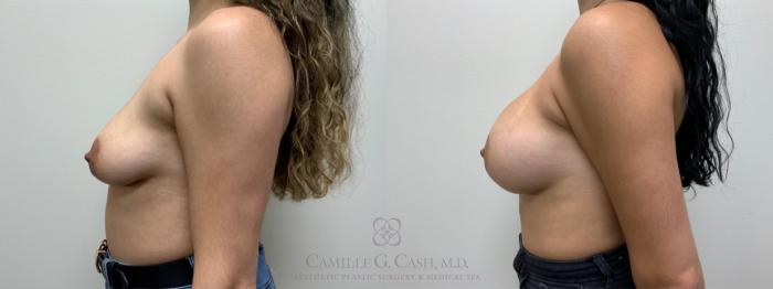 Before & After Breast Augmentation Case 638 Right Side View in Houston, TX