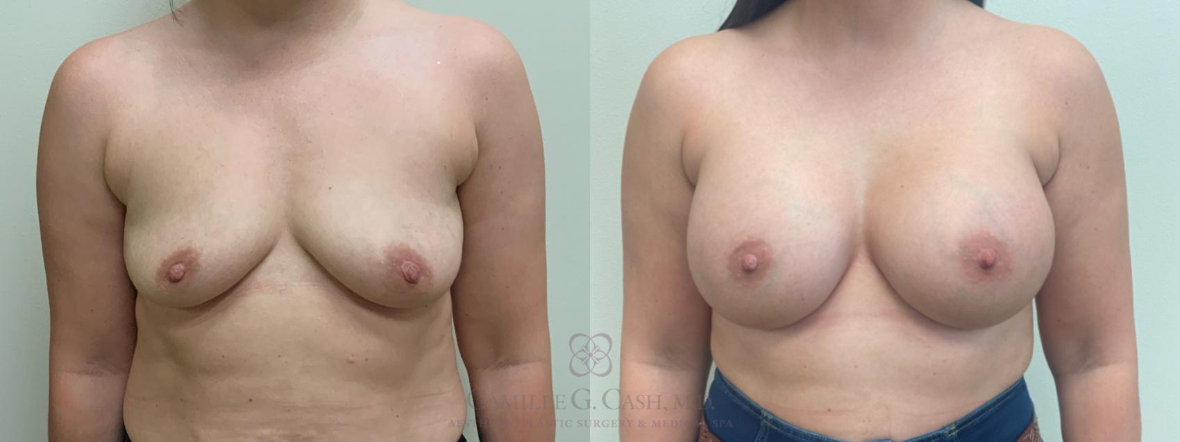 Before & After Breast Augmentation Case 639 Front View in Houston, TX
