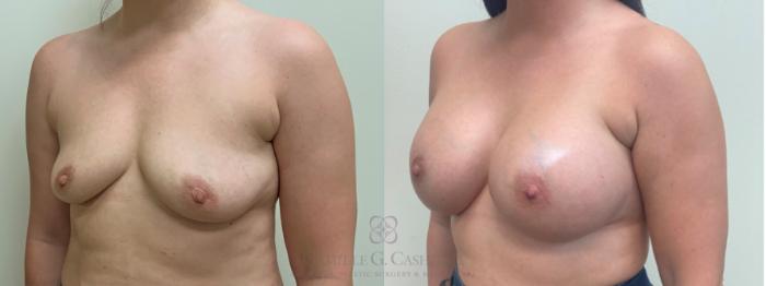Before & After Breast Augmentation Case 639 Left Oblique View in Houston, TX