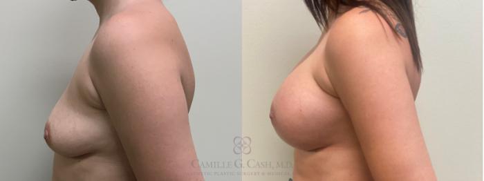 Before & After Breast Augmentation Case 639 Left Side View in Houston, TX