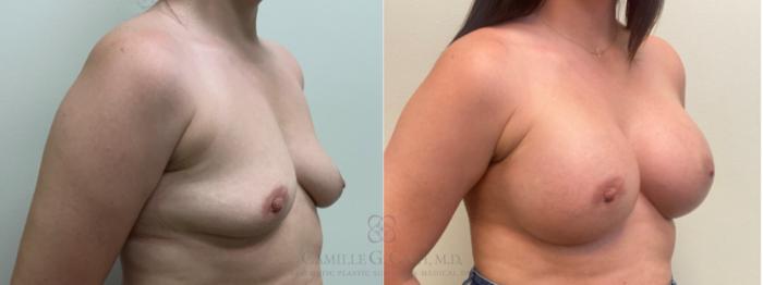Before & After Breast Augmentation Case 639 Right Oblique View in Houston, TX