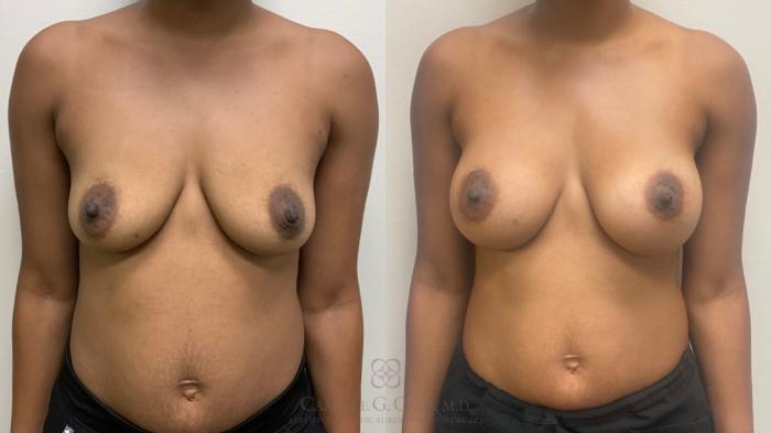 Before & After Breast Augmentation Case 642 Front View in Houston, TX