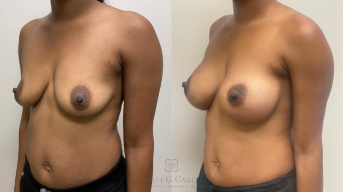 Before & After Breast Augmentation Case 642 Left Oblique View in Houston, TX
