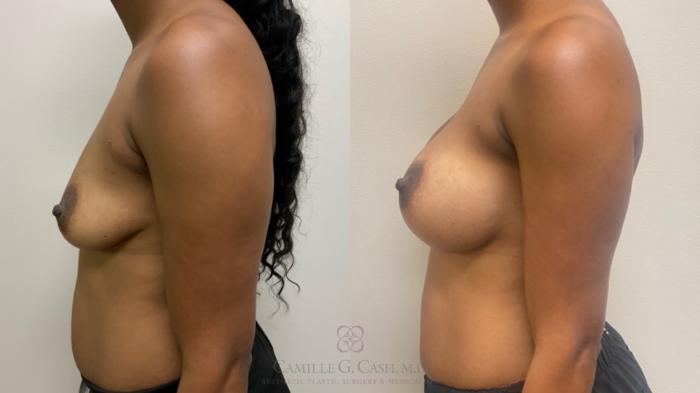 Before & After Breast Augmentation Case 642 Left Side View in Houston, TX