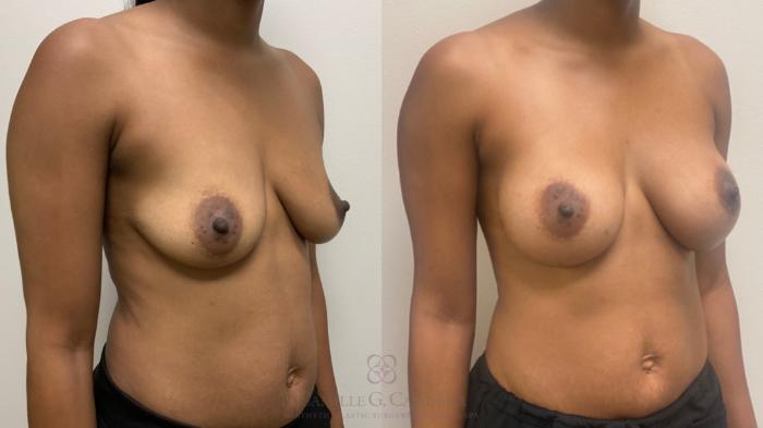 Before & After Breast Augmentation Case 642 Right Oblique View in Houston, TX
