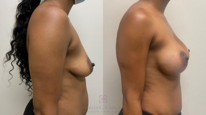 Before & After Breast Augmentation Case 642 Right Side View in Houston, TX
