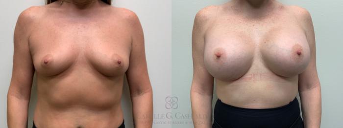Before & After Breast Augmentation Case 644 Front View in Houston, TX