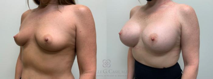 Before & After Breast Augmentation Case 644 Left Oblique View in Houston, TX