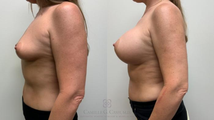Before & After Breast Augmentation Case 644 Left Side View in Houston, TX