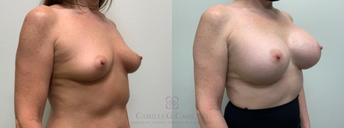 Before & After Breast Augmentation Case 644 Right Oblique View in Houston, TX