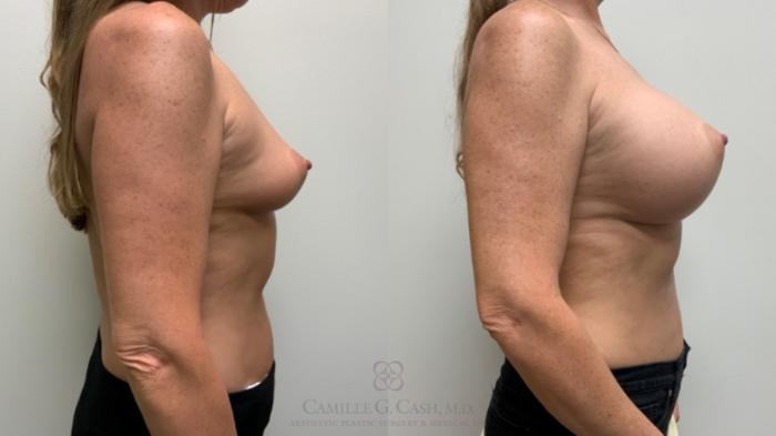 Before & After Breast Augmentation Case 644 Right Side View in Houston, TX