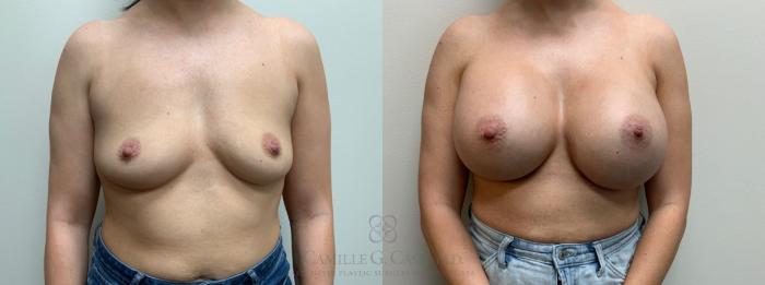 Before & After Breast Augmentation Case 667 Front View in Houston, TX
