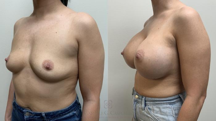 Before & After Breast Augmentation Case 667 Left Oblique View in Houston, TX