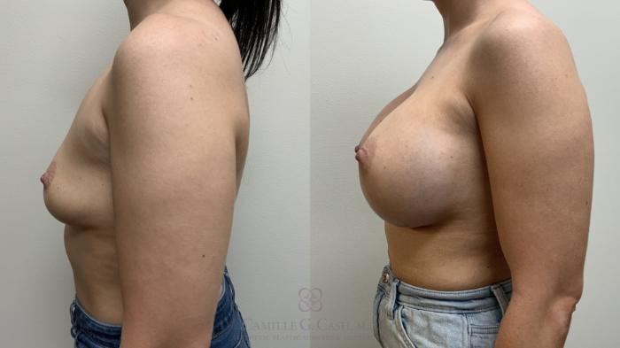 Before & After Breast Augmentation Case 667 Left Side View in Houston, TX