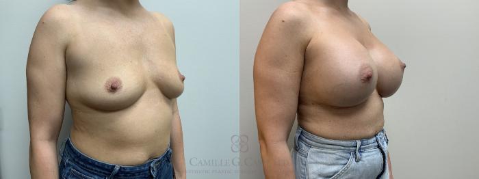 Before & After Breast Augmentation Case 667 Right Oblique View in Houston, TX