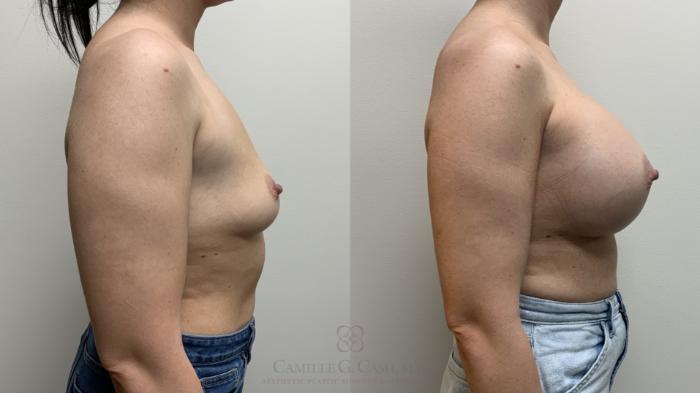 Before & After Breast Augmentation Case 667 Right Side View in Houston, TX