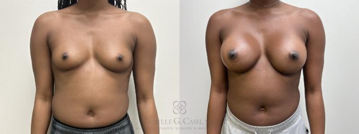 Before & After Breast Augmentation Case 679 front 12 weeks View in Houston, TX