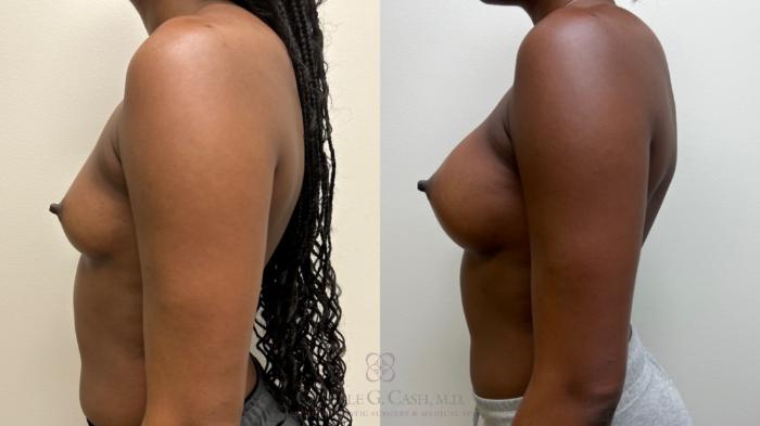 Before & After Breast Augmentation Case 679 Left Side View in Houston, TX