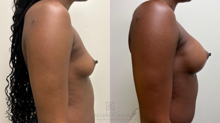 Before & After Breast Augmentation Case 679 Right Side View in Houston, TX