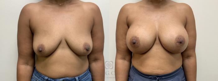 Before & After Breast Augmentation Case 685 Front View in Houston, TX
