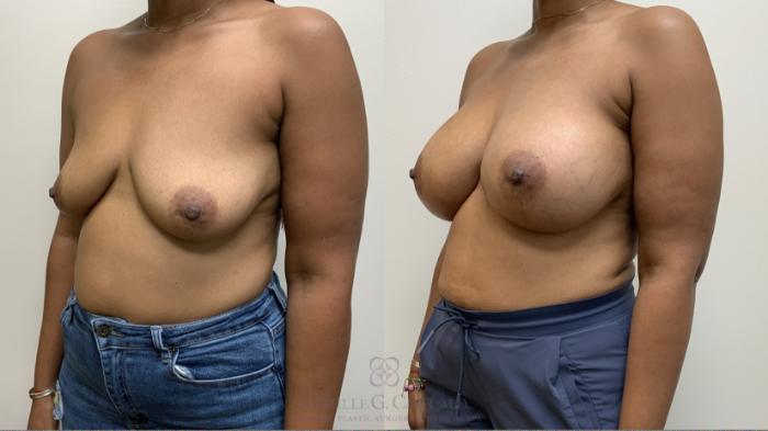 Before & After Breast Augmentation Case 685 Left Oblique View in Houston, TX