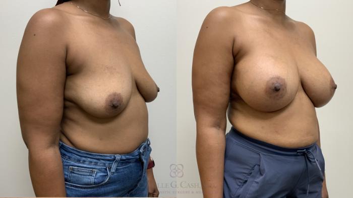Before & After Breast Augmentation Case 685 Right Oblique View in Houston, TX