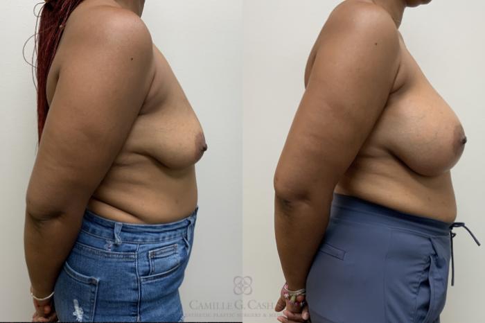 Before & After Breast Augmentation Case 685 Right Side View in Houston, TX