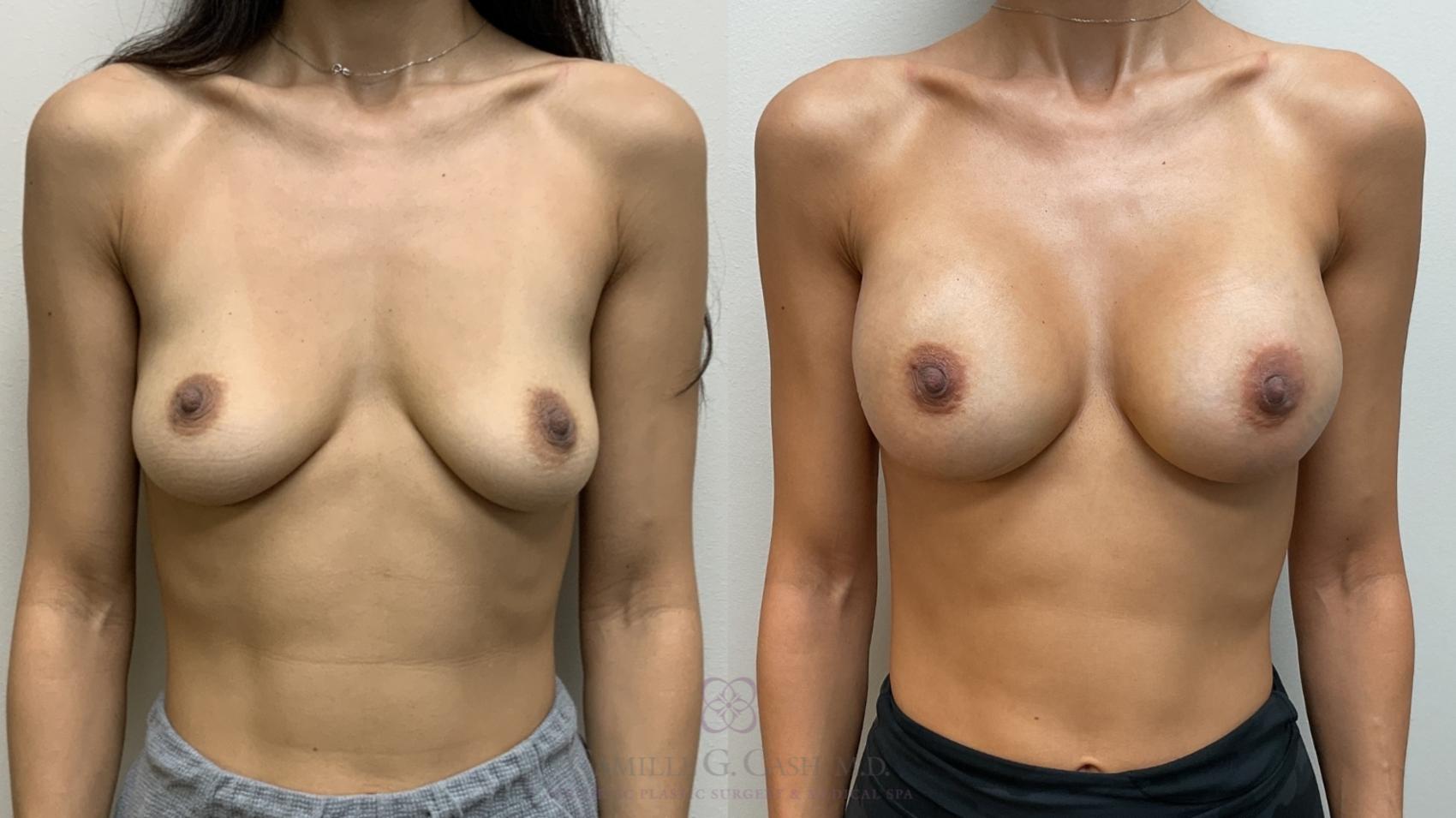 Before & After Breast Augmentation Case 714 Front View in Houston, TX