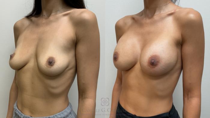 Before & After Breast Augmentation Case 714 Left Oblique View in Houston, TX