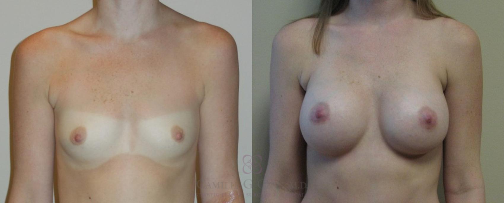 Before & After Breast Augmentation Case 85 View #1 View in Houston, TX