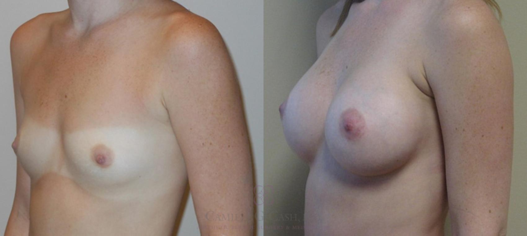 Before & After Breast Augmentation Case 85 View #2 View in Houston, TX