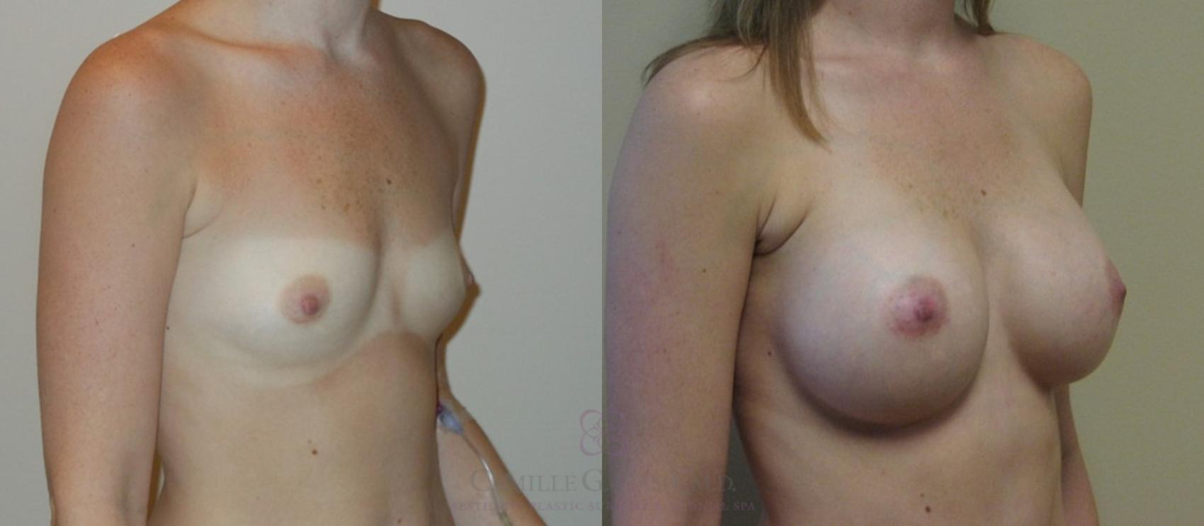 Before & After Breast Augmentation Case 85 View #3 View in Houston, TX