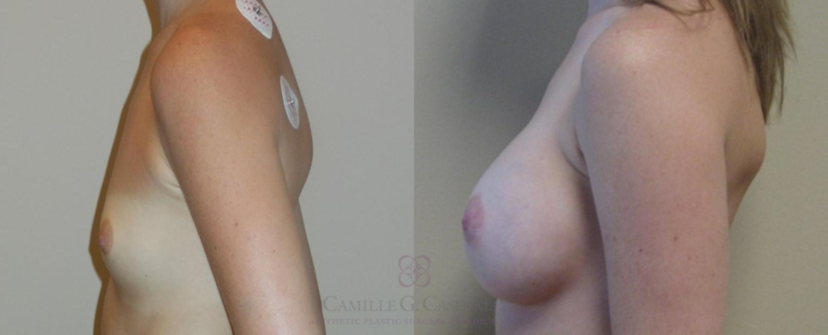 Before & After Breast Augmentation Case 85 View #4 View in Houston, TX