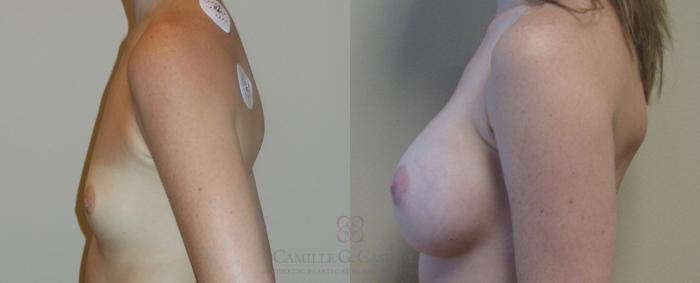 Before & After Breast Augmentation Case 85 View #4 View in Houston, TX