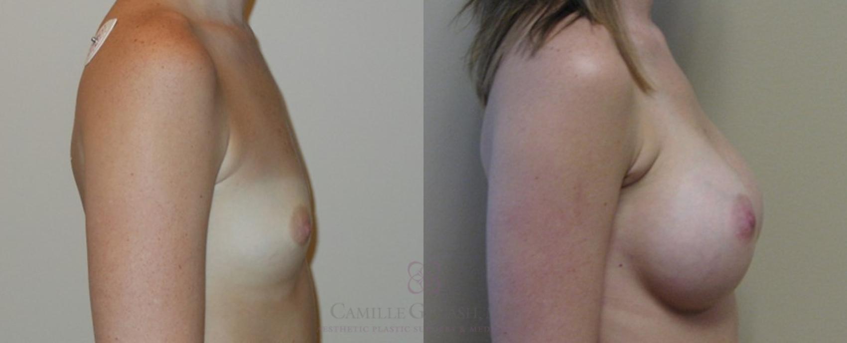 Before & After Breast Augmentation Case 85 View #5 View in Houston, TX