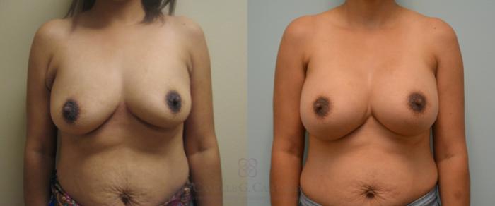 Before & After Breast Augmentation Case 90 View #2 View in Houston, TX