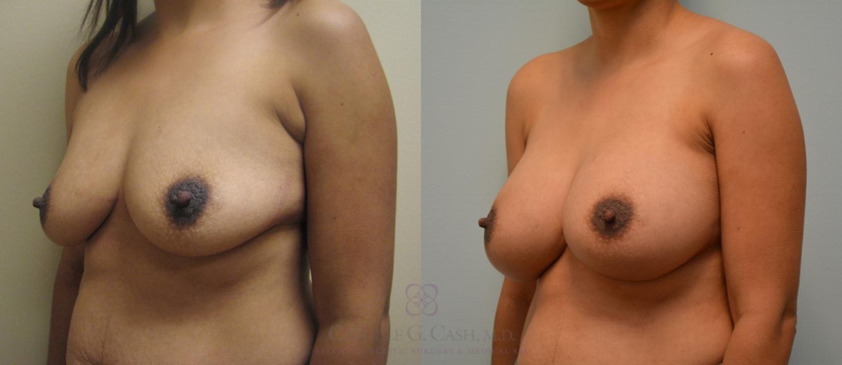 Before & After Breast Augmentation Case 90 View #3 View in Houston, TX