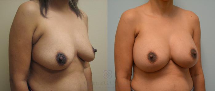 Before & After Breast Augmentation Case 90 View #4 View in Houston, TX