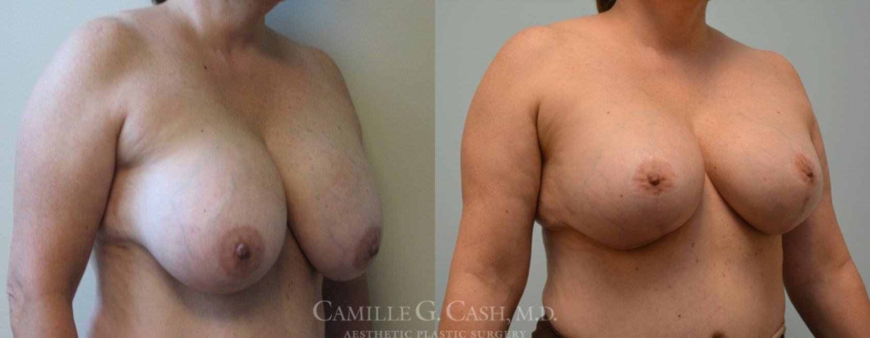 Before & After Breast Implant Removal Case 100 View #2 View in Houston, TX