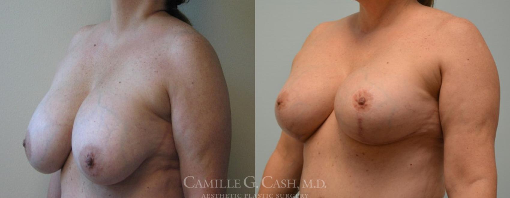 Before & After Breast Implant Removal Case 100 View #3 View in Houston, TX
