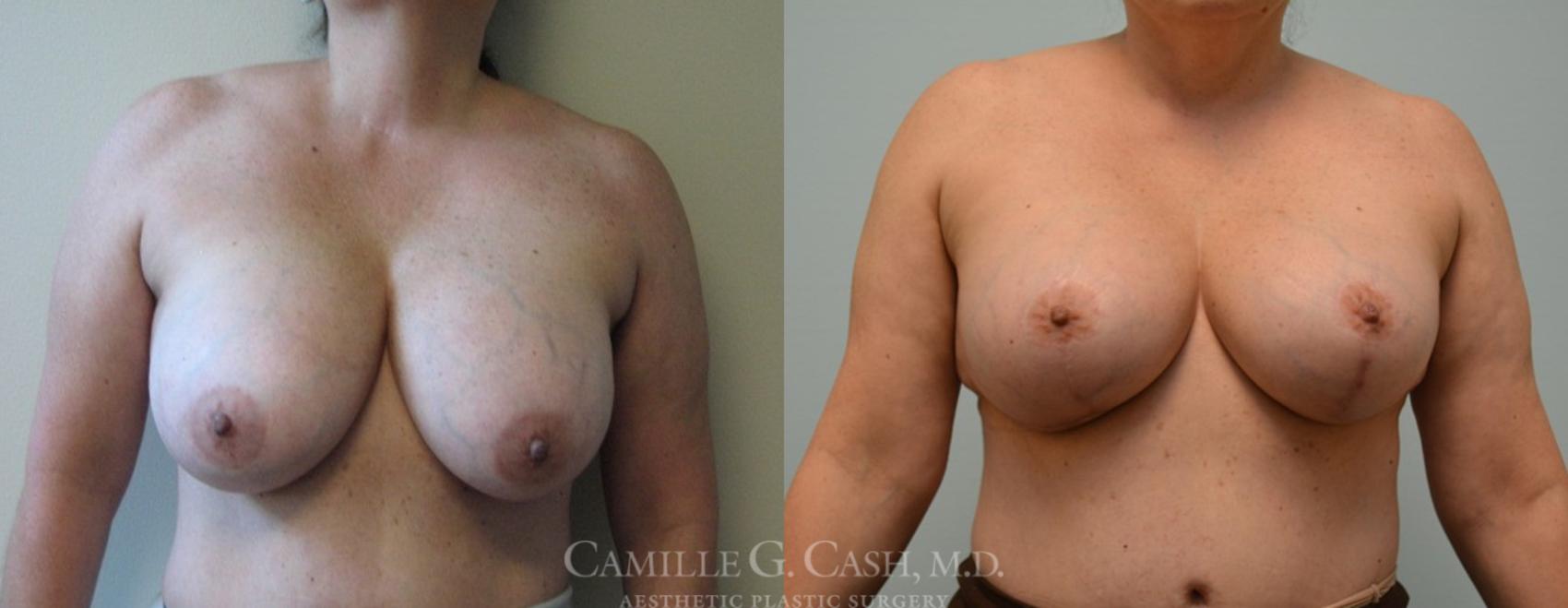 Before & After Breast Implant Removal Case 100 View #4 View in Houston, TX