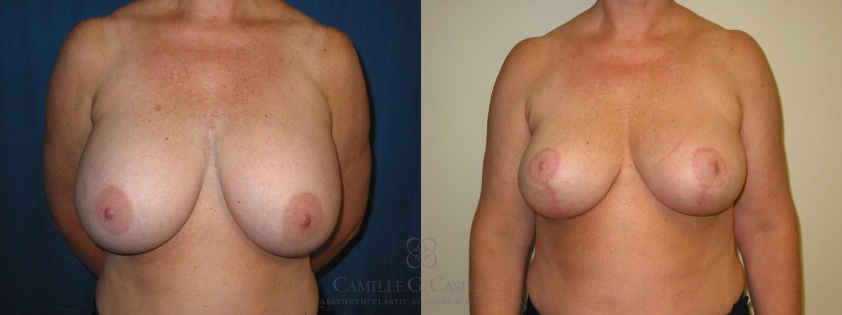 Before & After Breast Implant Removal Case 116 View #1 View in Houston, TX