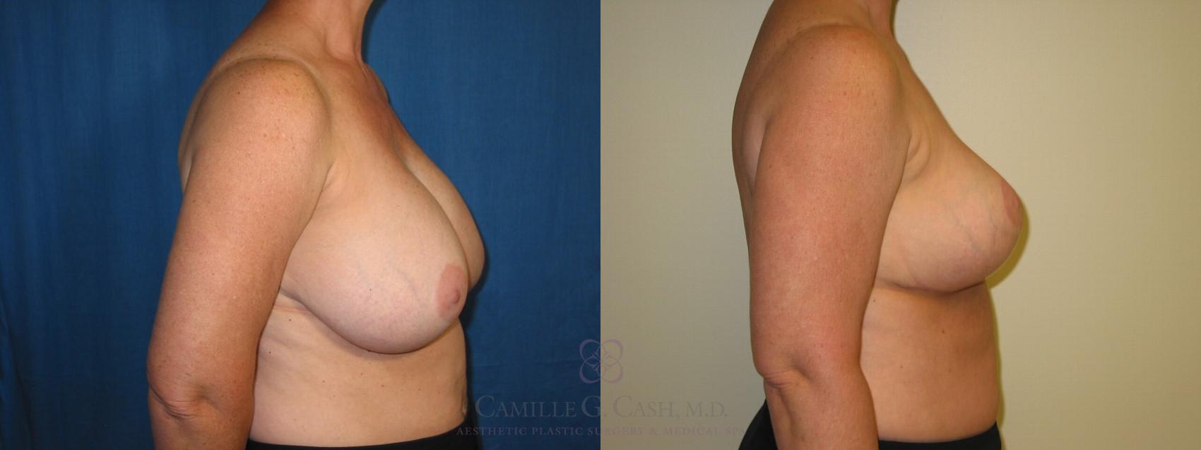Before & After Breast Implant Removal Case 116 View #2 View in Houston, TX