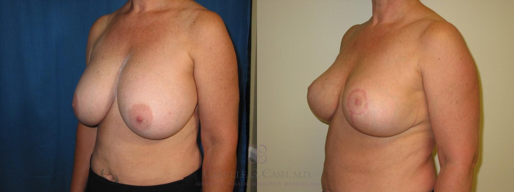 Before & After Breast Implant Removal Case 116 View #3 View in Houston, TX