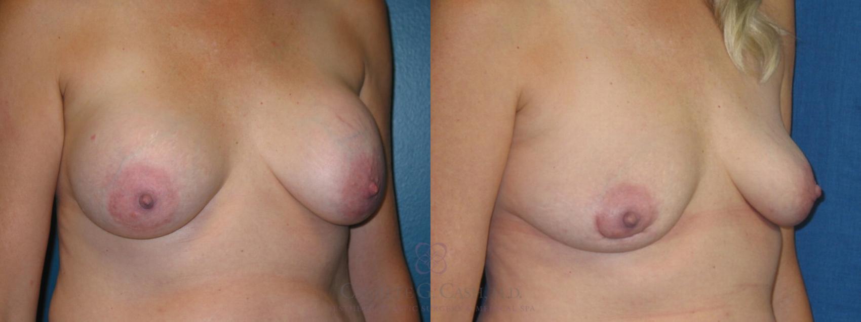 Before & After Breast Implant Removal Case 182 View #1 View in Houston, TX