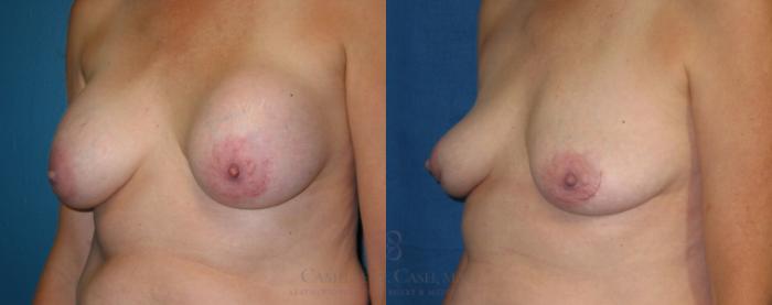 Before & After Breast Implant Removal Case 182 View #2 View in Houston, TX