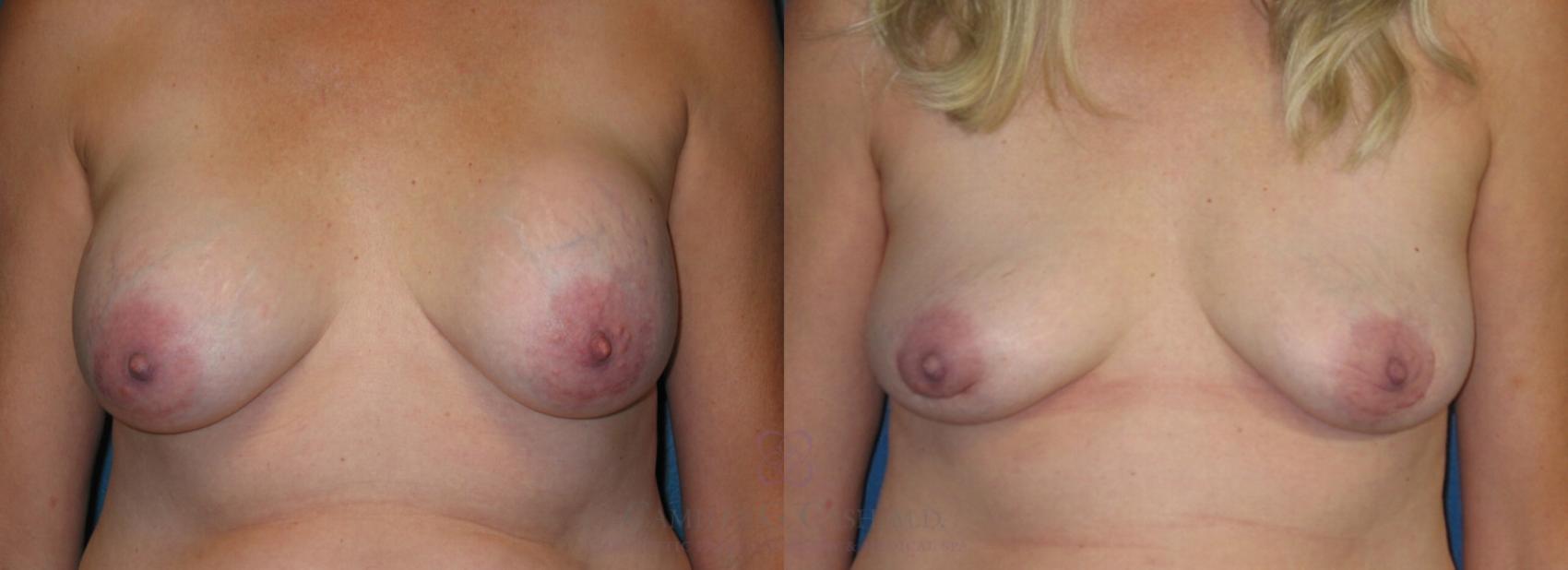Before & After Breast Implant Removal Case 182 View #3 View in Houston, TX